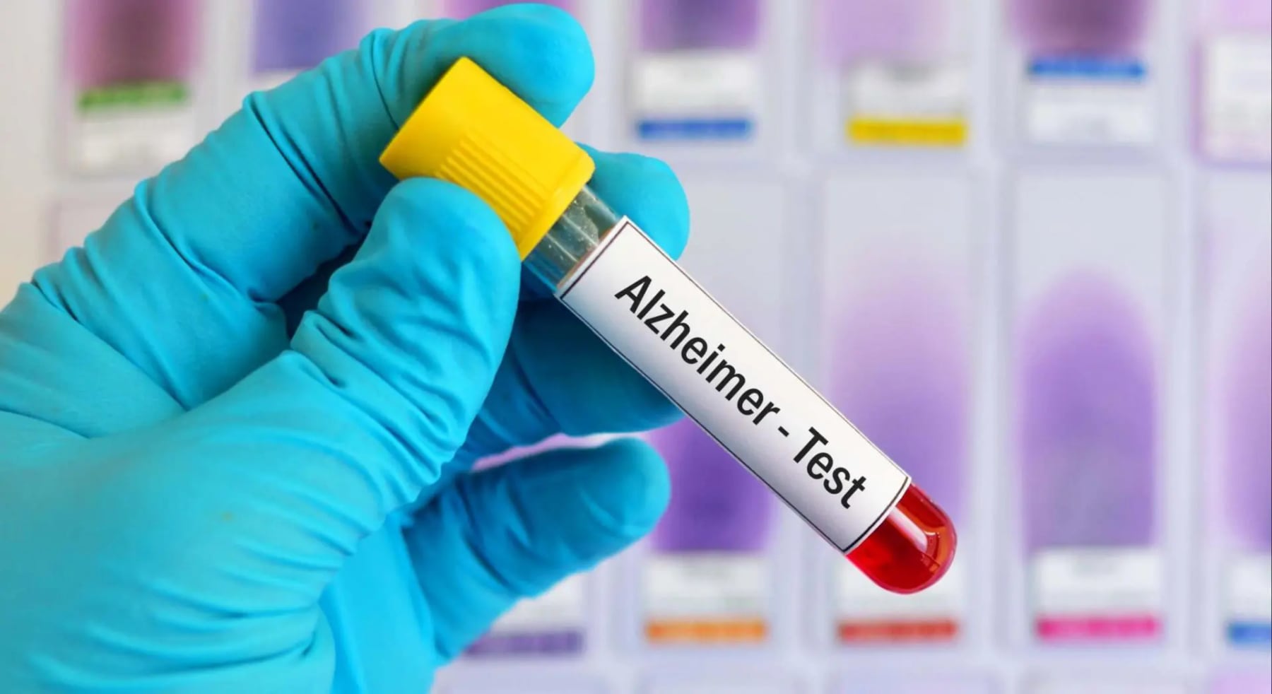 Revolucionario análisis de sangre podría rastrear progresión del Alzheimer