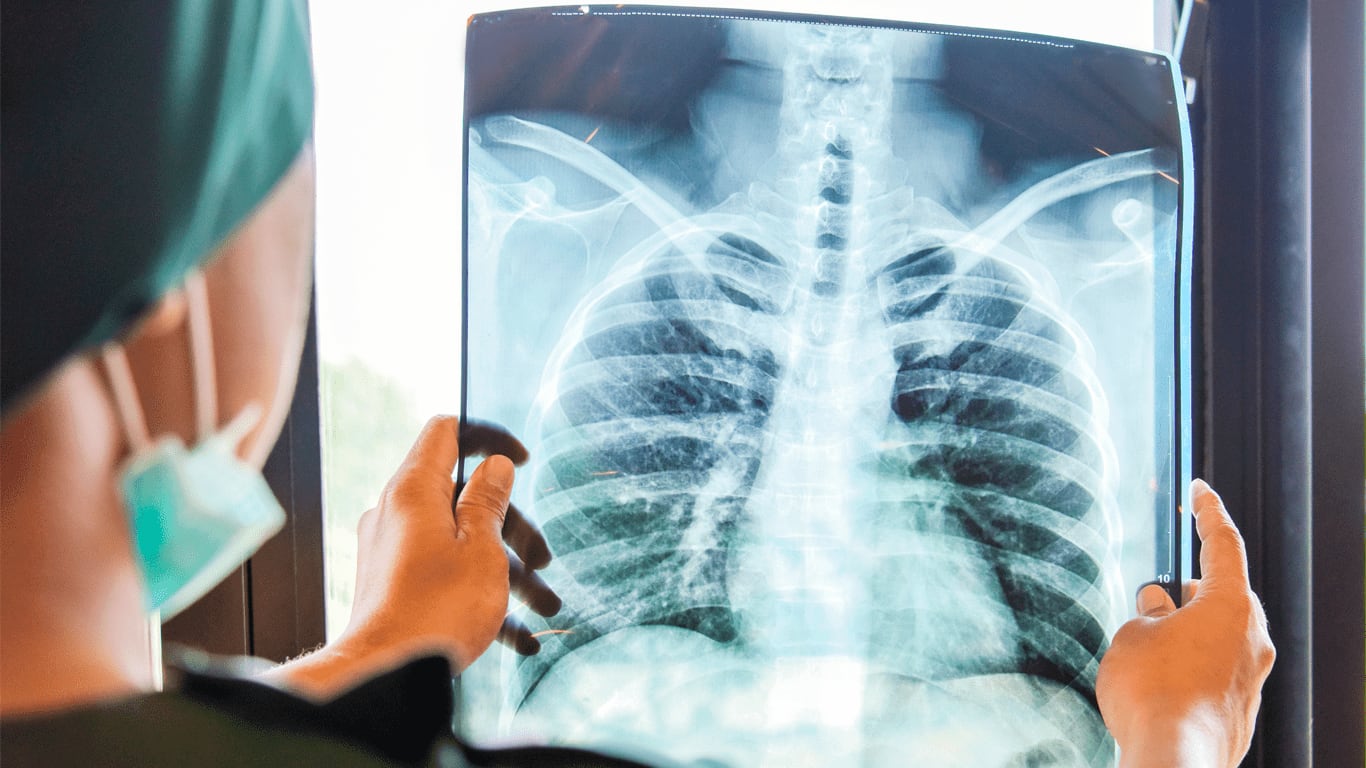 El tumor más mortal en el país: cómo anticiparse al cáncer de pulmón