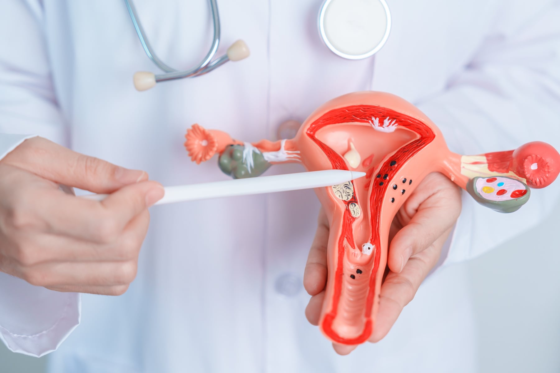 Detectar a tiempo el cáncer de ovario: dificultades y signos a los que estar atentos