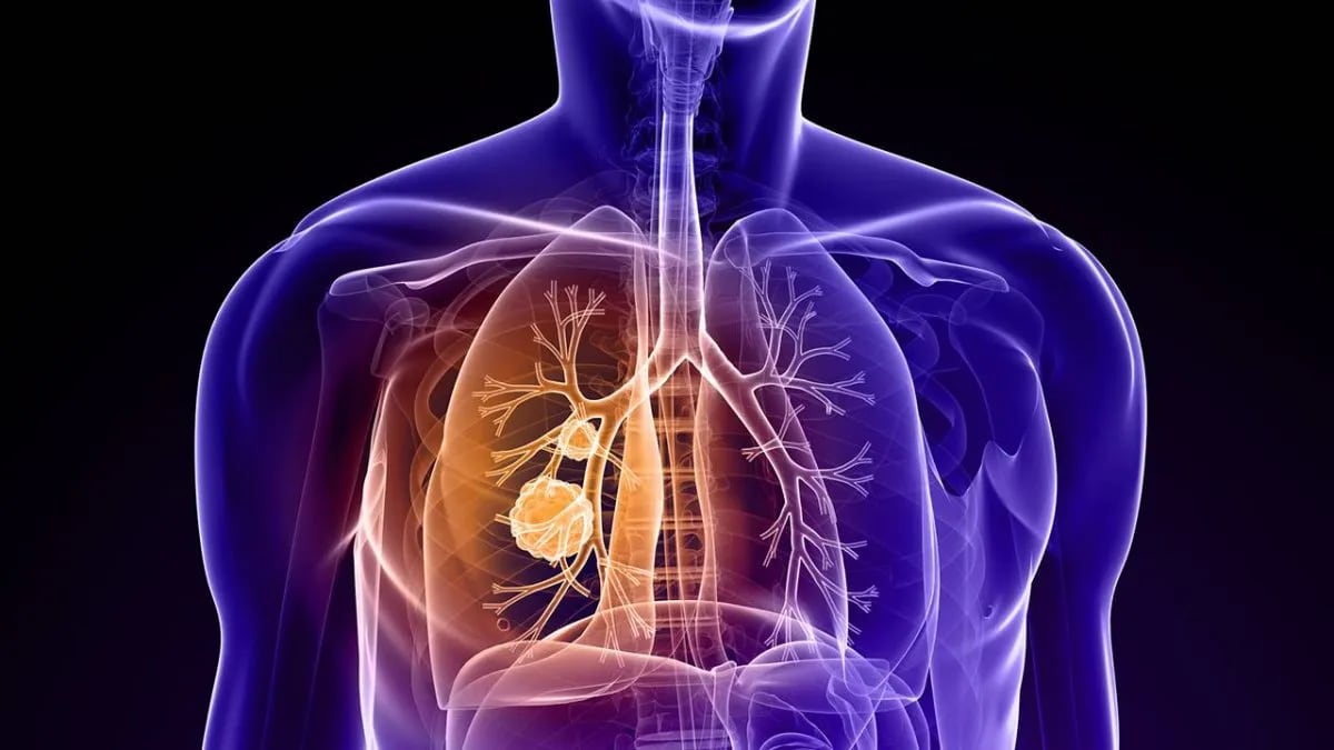 Nuevo avance en cáncer de pulmón: logran identificar tumores como si tuvieran DNI para ajustar los tratamientos