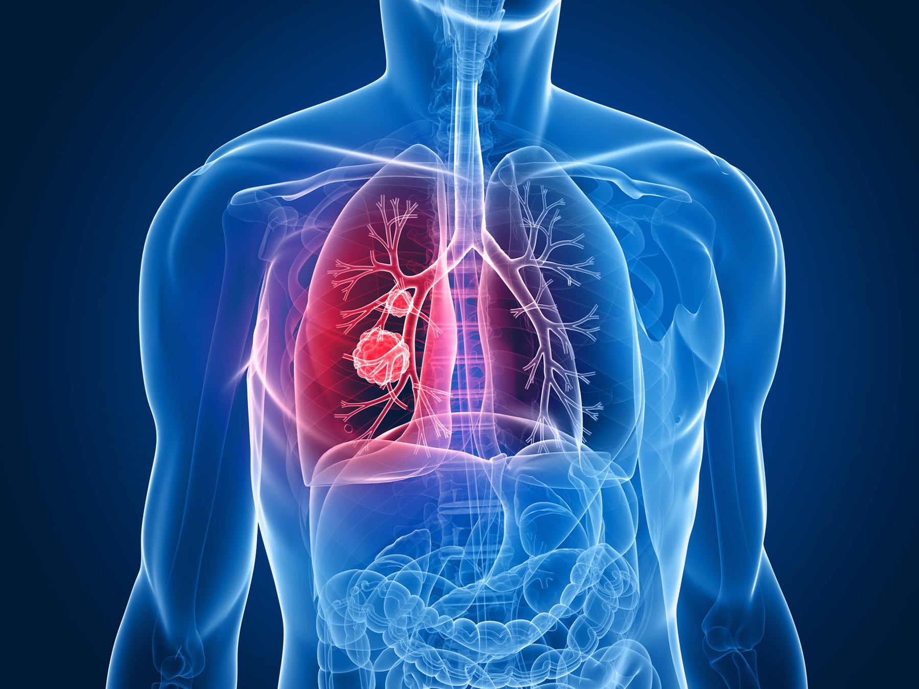 Enfermedades frecuentes que afectan a los pulmones